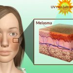 90% людей с этим состоянием кожи являются женщинами