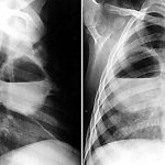 Абсцесс легкого - причины