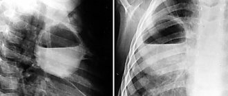 Lung abscess - causes
