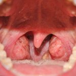 Аденоиды у взрослых: симптомы