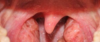 Adenoids in adults: symptoms