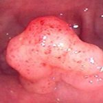 аденоматозный полип