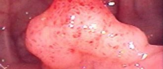 adenomatous polyp