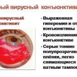 Adenoviral conjunctivitis