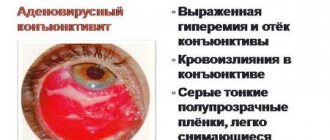 Аденовирусный конъюнктивит