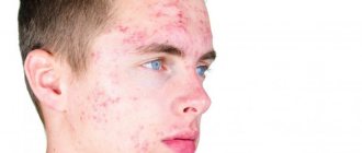 acne