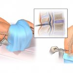 Анализ спинномозговой жидкости