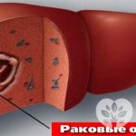 Ангиосаркома печени