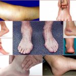 Arthritis of the ankle - external data of pathology