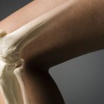 Arthropathy of the leg joints