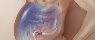 ascites