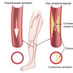 atherosclerosis