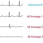 Атриовентрикулярная блокада на электрокардиограмме