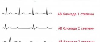 Atrioventricular block on the electrocardiogram