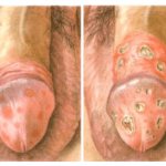 Balanitis and balanoposthitis