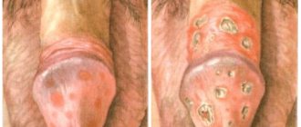Balanitis and balanoposthitis