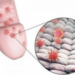 Balanoposthitis in a child. Photos, symptoms and treatment, clinical recommendations, doctor&#39;s advice, video 