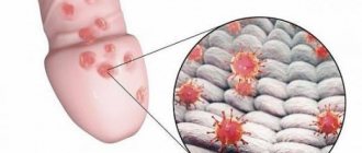 Balanoposthitis in a child. Photos, symptoms and treatment, clinical recommendations, doctor&#39;s advice, video 