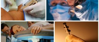 lymph node biopsy