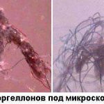 Morgellons disease - symptoms and treatment, photos and videos.