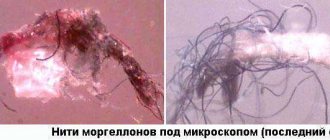 Morgellons disease - symptoms and treatment, photos and videos.