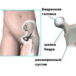 болезнь пертеса симптоматика