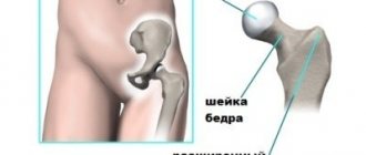 Perthes disease symptoms