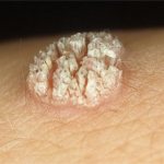 Бородавки - неприятный косметический дефект и они могут появляться на всех частях тела