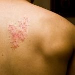 How to treat herpes zoster