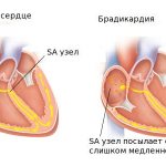 Что такое Брадикардия сердца и как ее лечить
