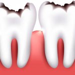 что такое кариес