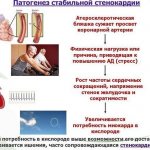 Что такое стенокардия