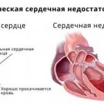 symptoms of chronic heart failure