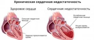 cимптомы хронической сердечной недостаточности