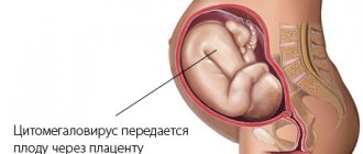 cytomegalovirus