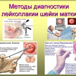 диагностика лейкоплакии