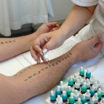 Diagnosis of the disease is based on skin tests