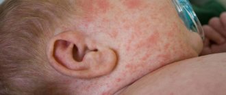 Диатез у детей на щеках и лице: симптомы, лечение, фото ...