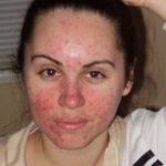 диатез у взрослых фото