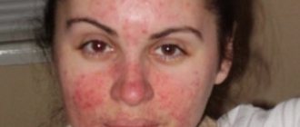 diathesis in adults photo