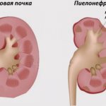 диета при пиелонефрите