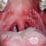 Для герпетической ангины характерно появление пузырьков, напоминающих герпес