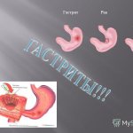 Duodeno gastric reflux gastritis
