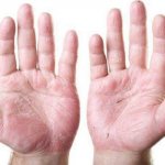 Экзема на ладонях