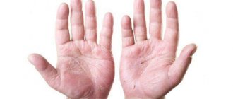 Eczema on the palms