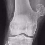 Экзостоз коленного сустава