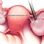 endometrioid ovarian cyst