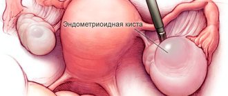 эндометриоидная киста яичника