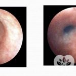 Endoscopic picture of bronchospasm, on the left – before, on the right – after the attack
