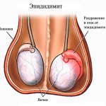 Эпидидимит у мужчин